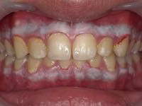 術直後（約2～7日、歯ぐきが白くなる）