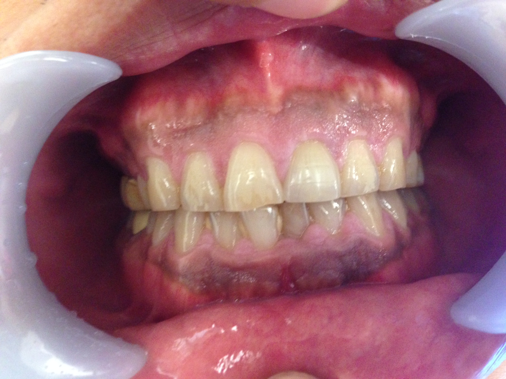 歯茎の色でお悩みの方