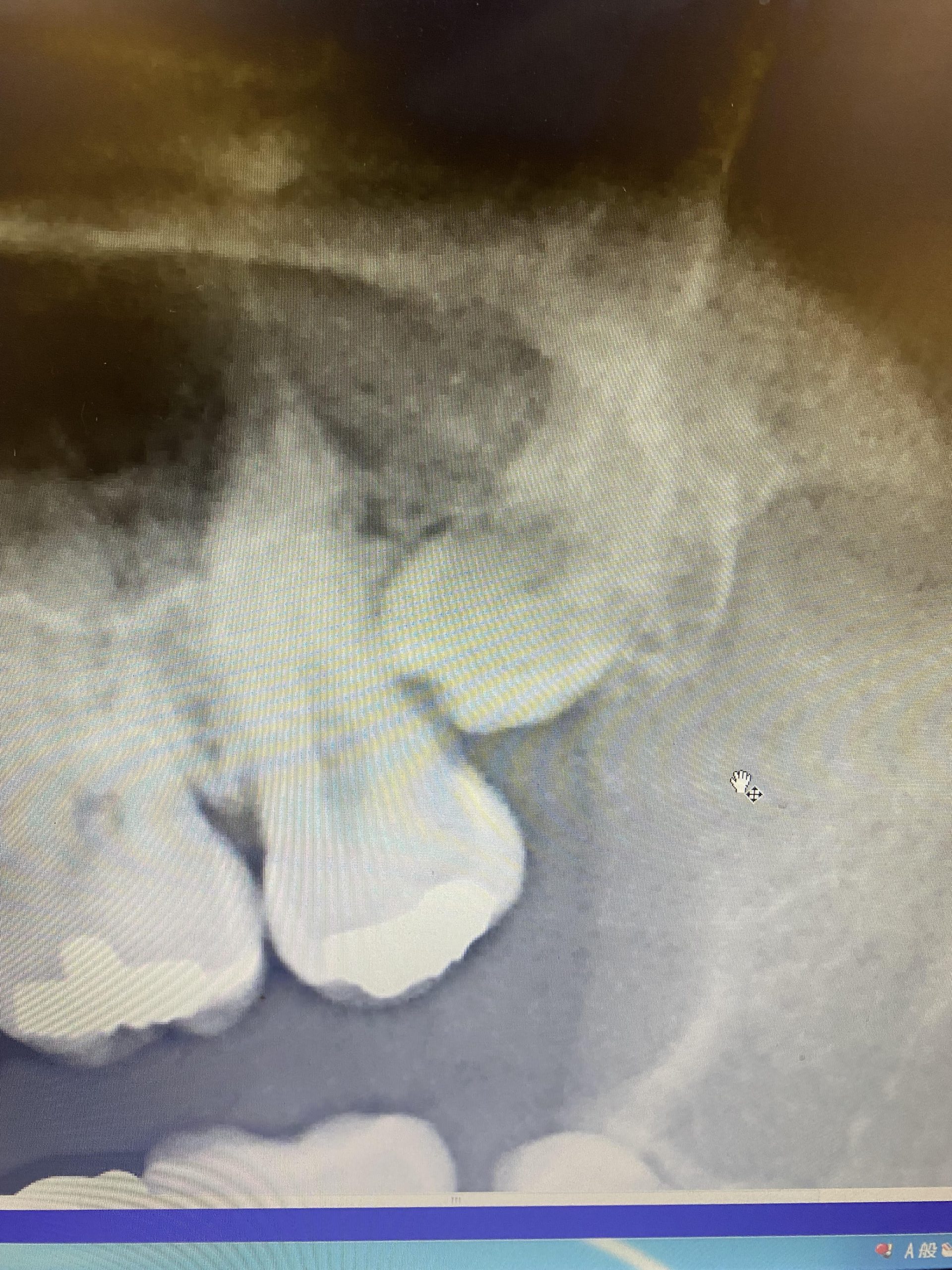 矯正のための抜歯