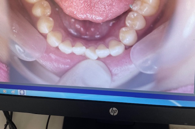 マウスピース矯正経過