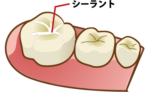 シーラントを示すイラスト