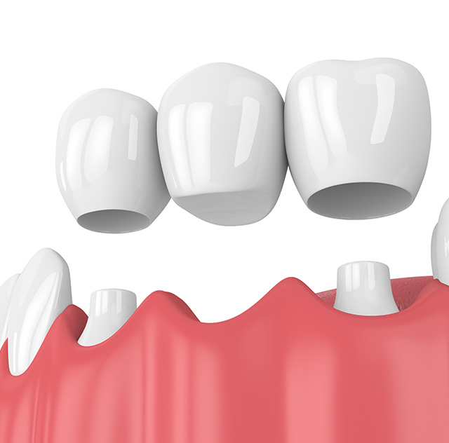 ブリッジのイメージ図