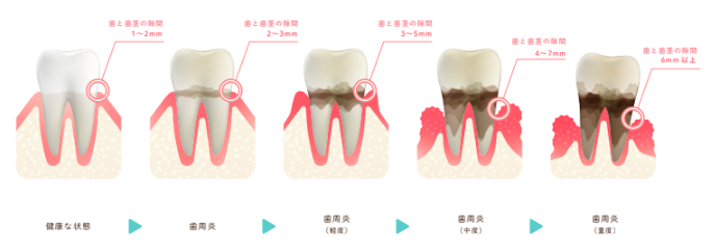 歯周病になる図解