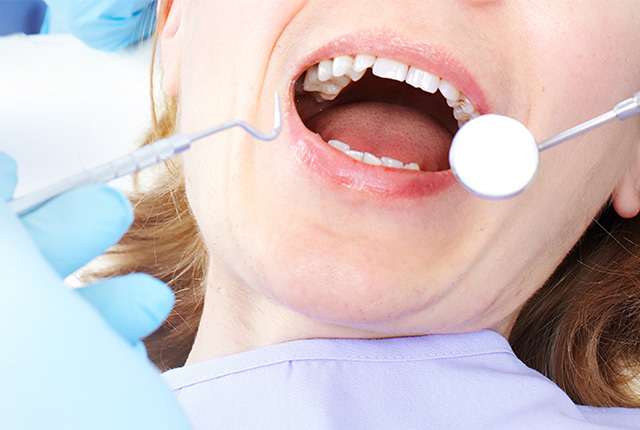 口を開けスケーリングされてる女性の口元