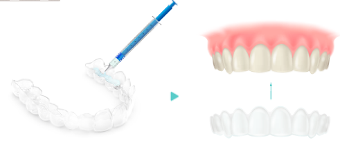 ホームホワイトニング