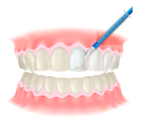 オフィスホワイトニング