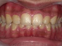 ガムピーリング術前