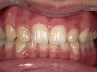 ガムピーリング術後