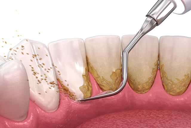 スケーリング（歯石取り）のイメージ図