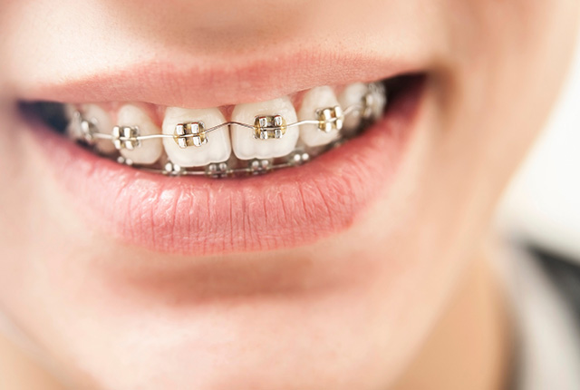 金属ブラケットを歯につけた男性