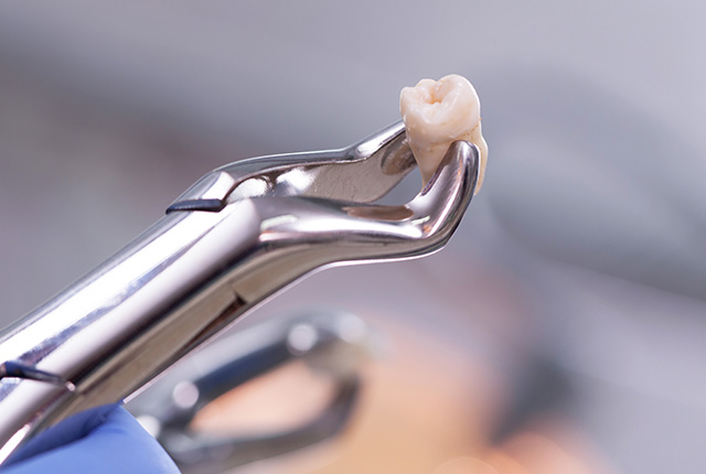 抜けた歯の拡大写真