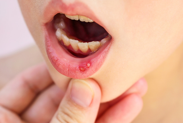 口内炎ができている