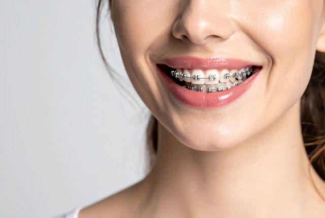 歯科矯正器具を付けて歯を見せて笑う女性